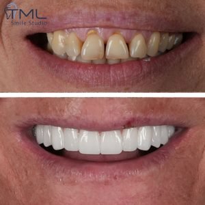 All-on-6 dental implants in Turkey